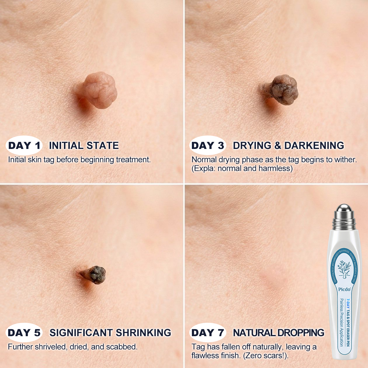 𝐏i𝐜𝐝o® 7-𝐷𝑎𝑦 𝗧𝐚𝐠 & 𝗦𝗽𝐨𝐭 𝐄𝐫𝒂𝒔𝒆𝒓(Zero Pain, Zero 𝐒𝐜𝐚𝒓𝒔 Rollerball)💙
