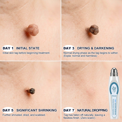 𝐏i𝐜𝐝o® 7-𝐷𝑎𝑦 𝗧𝐚𝐠 & 𝗦𝗽𝐨𝐭 𝐄𝐫𝒂𝒔𝒆𝒓(Zero Pain, Zero 𝐒𝐜𝐚𝒓𝒔 Rollerball)💙